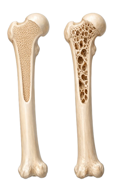 Osteoporosis: Weak Bones, Strong Risk